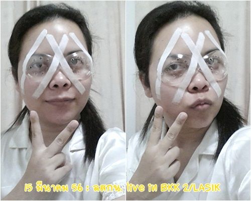 ลสกน กับประสบการณ์เลสิคจ้า