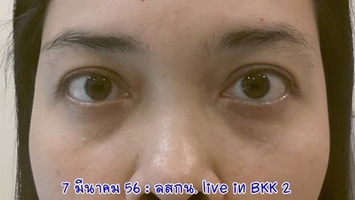 ลสกน กับประสบการณ์เลสิคจ้า