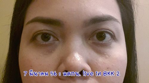 ลสกน กับประสบการณ์เลสิคจ้า