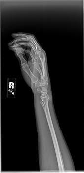 broken wrist