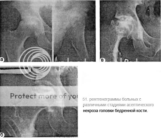 Некроз тазобедренный отзывы. Некроз тазобедренного сустава. Остеонекроз тазобедренного сустава 3 степени. Некроз тазобедренного сустава 3 степени. Воспаление тазобедренного сустава.